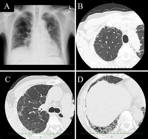 CT SCAN: High Resolution Chest CT .